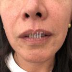 Lipofilling viso | Dott. D. De Fazio