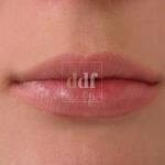 Filler labbra POST | Dott. D. De Fazio