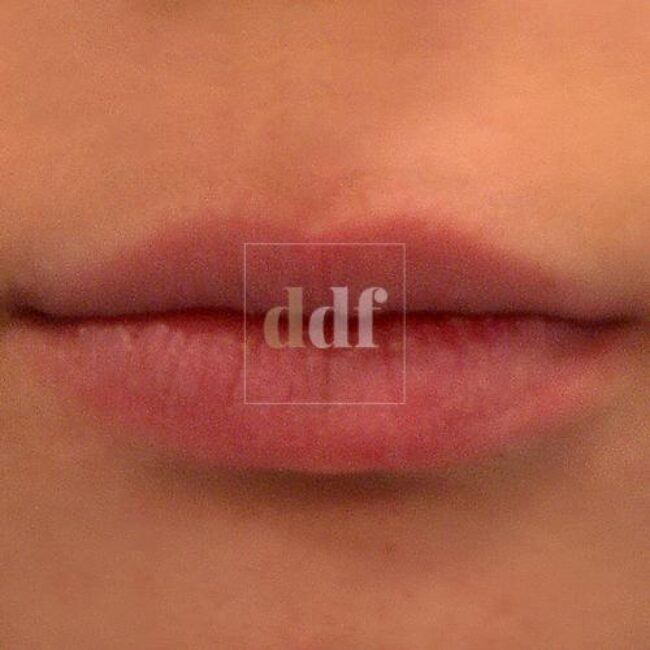 Filler labbra PRE | Dott. D. De Fazio